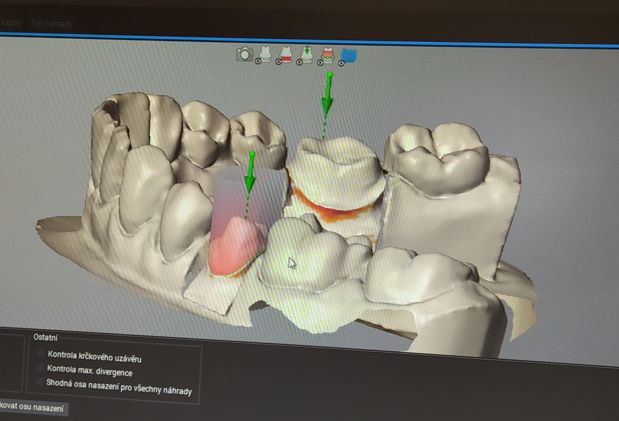 DentalWings a modelace v CAD softwaru